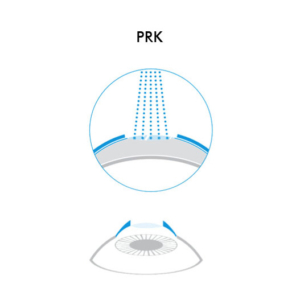 Icona PRK - Chirurgia Refrattiva Trattamenti laser correzione difetti visivi Vista Vision