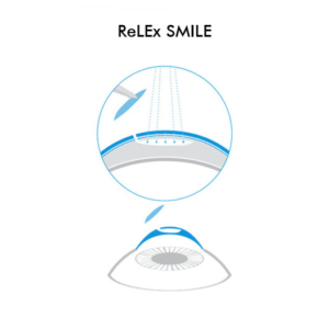 Icona ReLEx SMILE - Chirurgia Refrattiva Trattamenti laser correzione difetti visivi Vista Vision