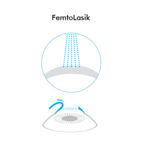 Icona FemtoLasik - Chirurgia Refrattiva Trattamenti laser correzione difetti visivi Vista Vision